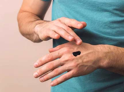 Місцеве нанесення RSO